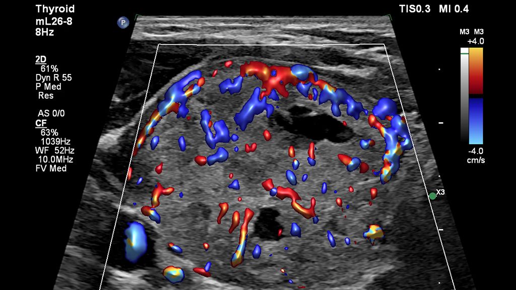 Clinical image using EPIQ Elite and mL26-8 to show thyroid goiter trapezoid with color