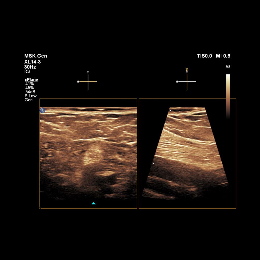 Clinical image of MSK Gen Pop Fossa Tibial Nerve X-Plane Chroma