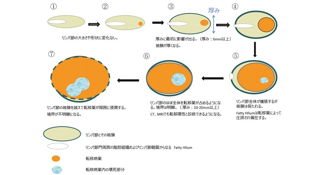 図5: 扁平上皮癌のリンパ節転移が形成される過程とその超音波画像の模式図*¹