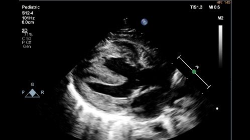 S12-4 2D Tetralogy of Fallot