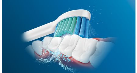 Sonic advanced technology removes food and plaque