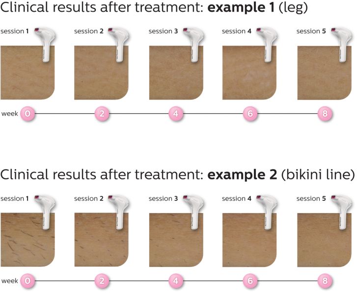 Philips Lumea Prestige