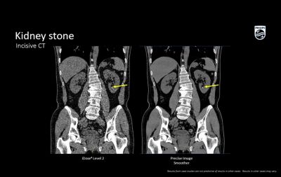 Incisive CT CT Scanner | Philips