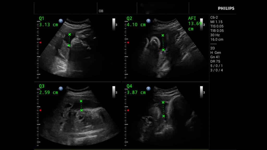 C6-2 OB Quad View AFI