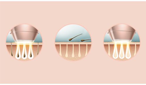 Professionelle IPL-Technologie für zu Hause, mit Dermatologen entwickelt