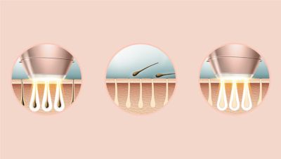 Expert IPL technology at-home, developed with dermatologists