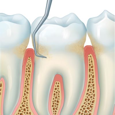 A periodontal probe probing a periodontal pocket.
