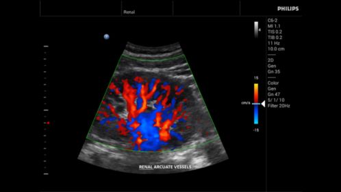 Innosight clinical image renal arcuate vessels