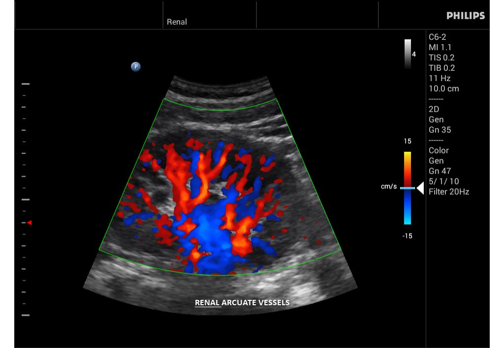 Innosight clinical image renal arcuate vessels