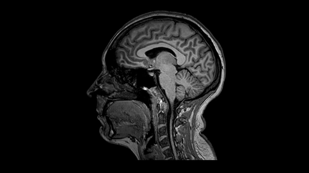 3D T1w TFE (MPRAGE) clinical image of the brain