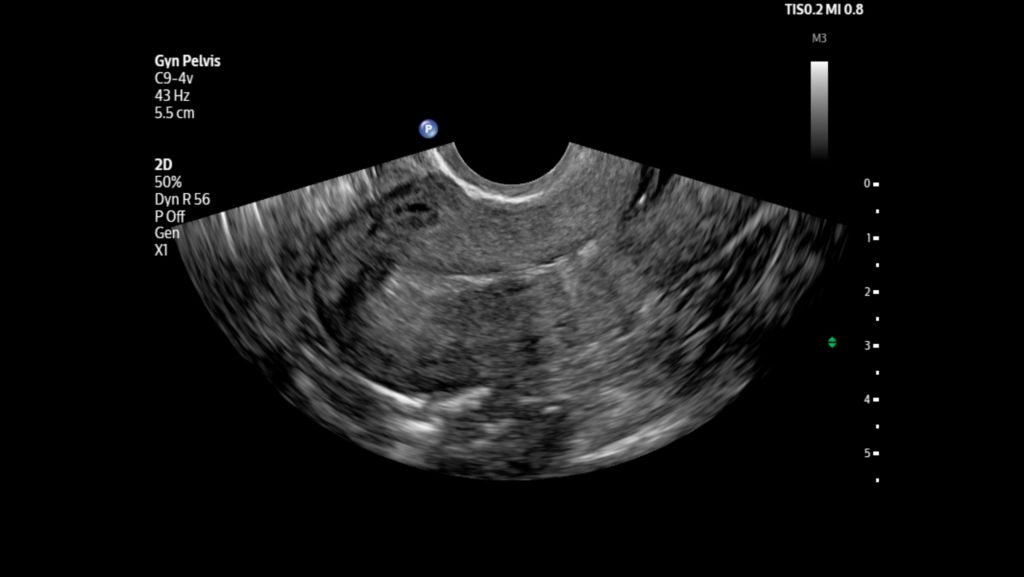 Uterus shown using C9-4v transducer.