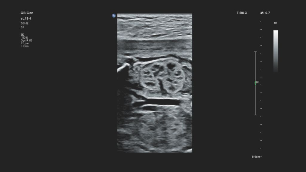 EPIQ Elite fetal kidney detail using the eL18-4