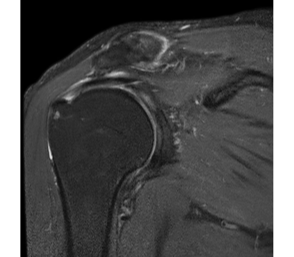 Coronal T2w SPAIR