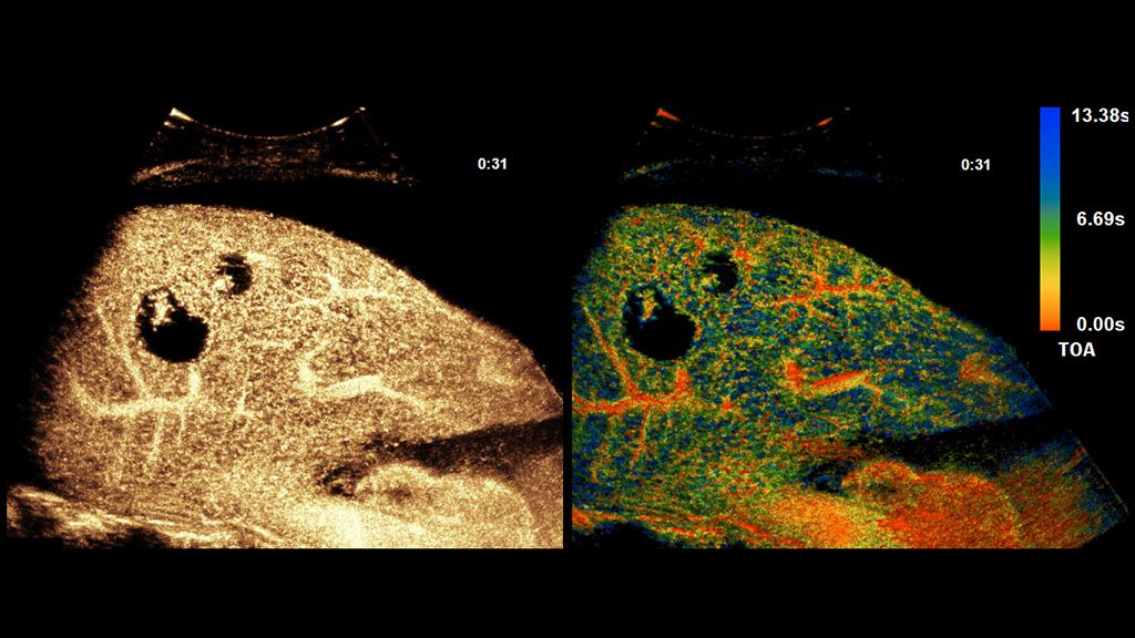 SuperRes MVI Pro clinical image showing multiple hemangiomas