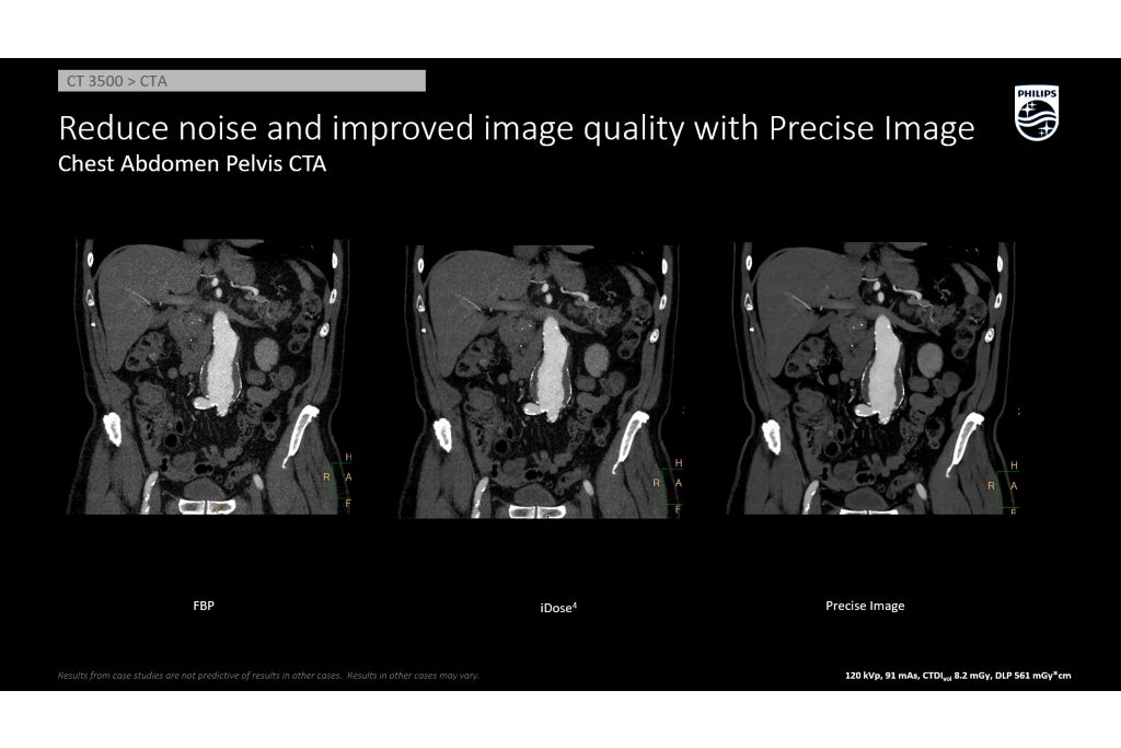 Chest Abd Pelvis Improved Image Quality AI Recon Precise Image