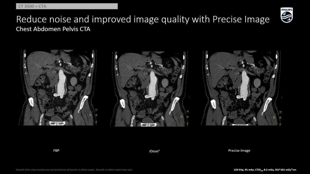 Chest Abd Pelvis Improved Image Quality AI Recon Precise Image