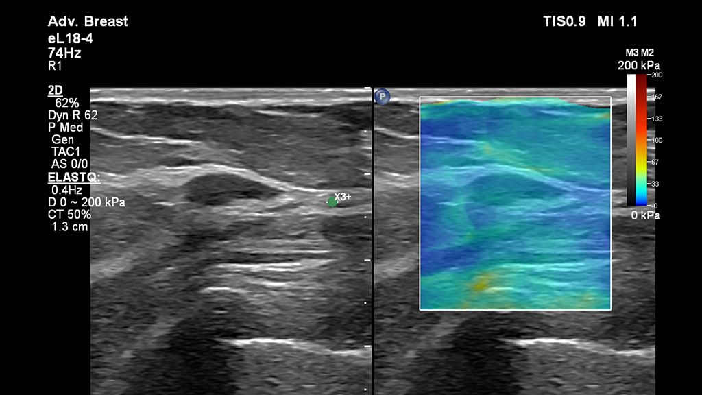 Clinical image using EPIQ Elite and eL18-4 transducer to show breast elastography fibroadenoma 