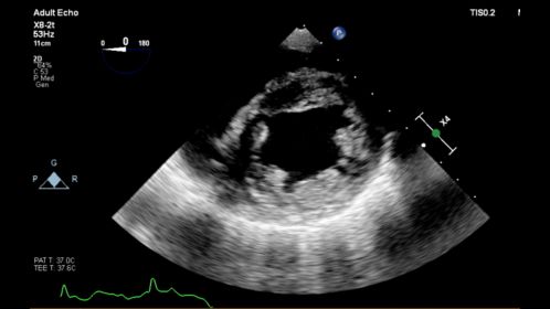 Affiniti CVx X8-2t Transgastric SAX