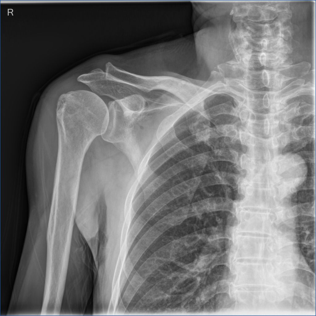 Quality digital X-ray images