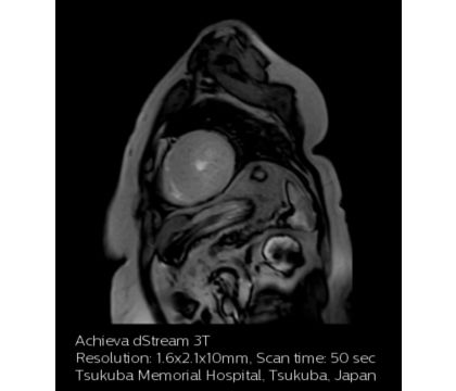 Cardiac Perfusion (hypertrophic myocardiopathy)