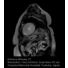 Cardiac Perfusion (hypertrophic myocardiopathy) thumbnail