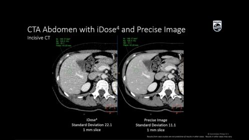 Incisive CT Abdomen avec iDose4 et Precise Image