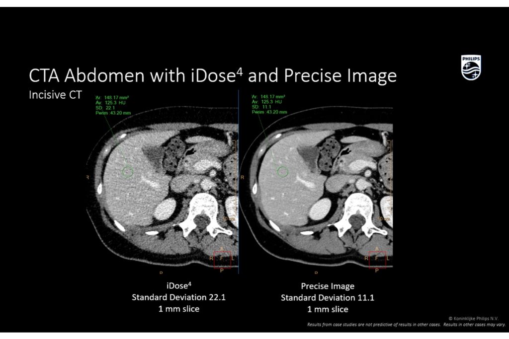 Incisive CT Abdomen with iDose4 and precise image