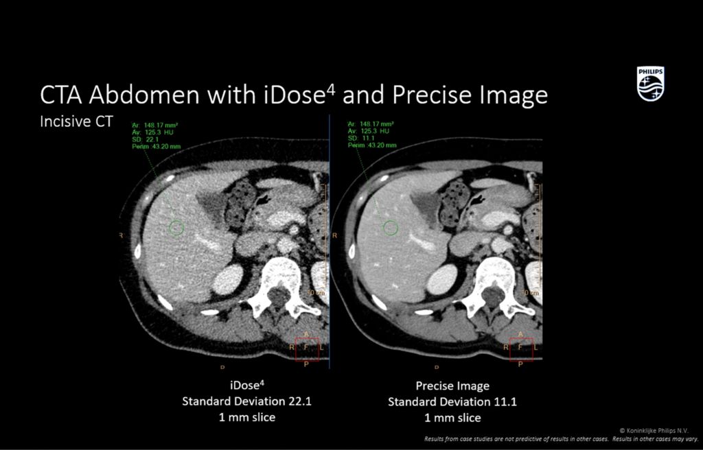 Incisive CT Abdomen with iDose4 and precise image