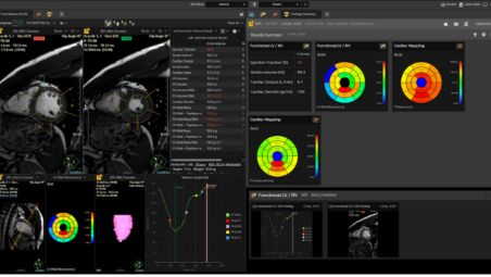 Flusso di lavoro di RM cardiaca personalizzato e basato sui risultati