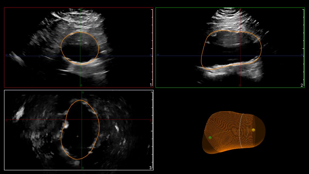 EPIQ utilizing the X6-1 transducer for the Philips AAA model on the Gallbladder