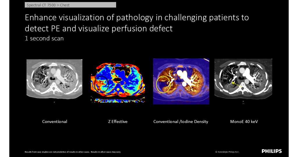CT Spectral 7500 Chest - Enhance visualization of pathology in challenging patients to detect PE and visualize perfusion defect