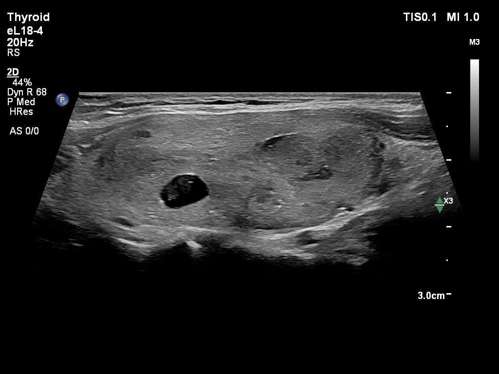 eL18-4 Thyroid EPIQ Goiter Trapezoid