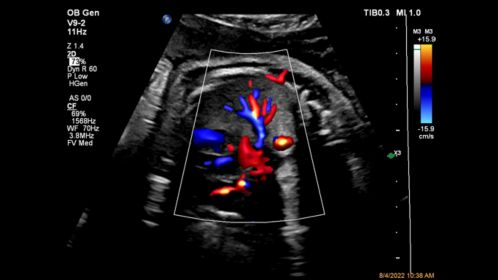 V9-2 Fetal Lung Perfusion with Flow Viewer