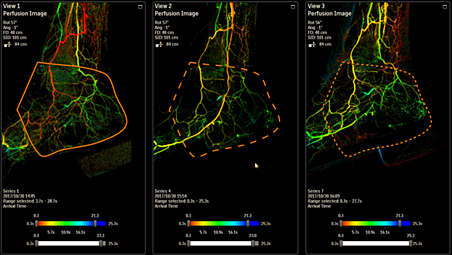 Compare up to 3 perfusion images
