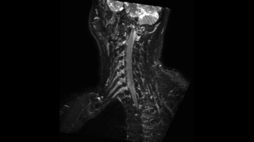 3D NerveVIEW (right oblique reformat)
