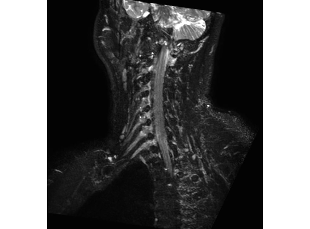3D NerveVIEW (right oblique reformat)
