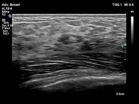 eL18-4 Adv Breast