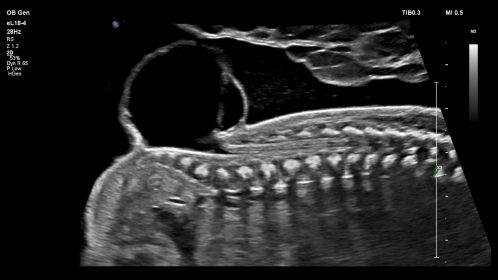 eL18-4 OB Fetal Spine