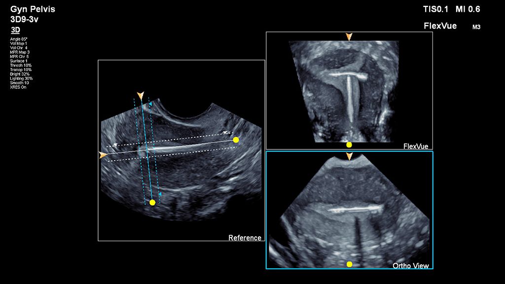 Complete projected coronal view of the uterus with IUD using FlexVue with Orthogonal View