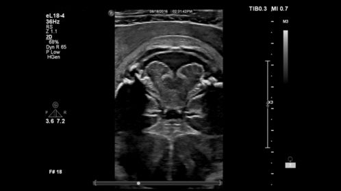 Fetal brain - eL18-4