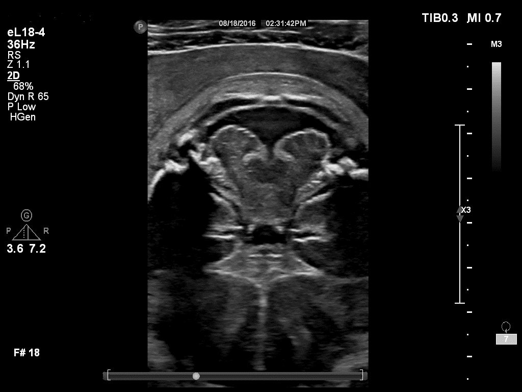 Fetal brain - eL18-4