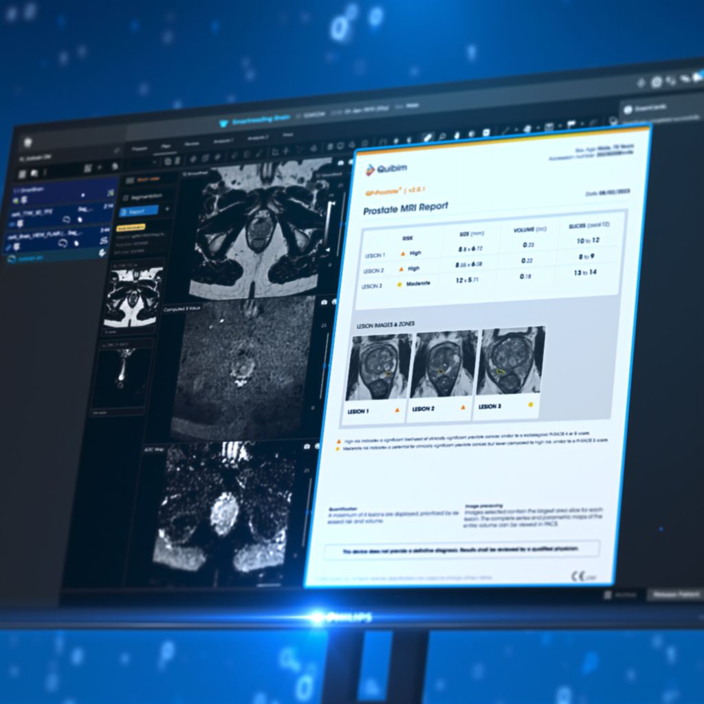 Smart Reading quantitative report of Quibim's QP-prostate on the mr console