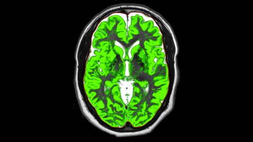 Segmentation Grey matter (synthetic)