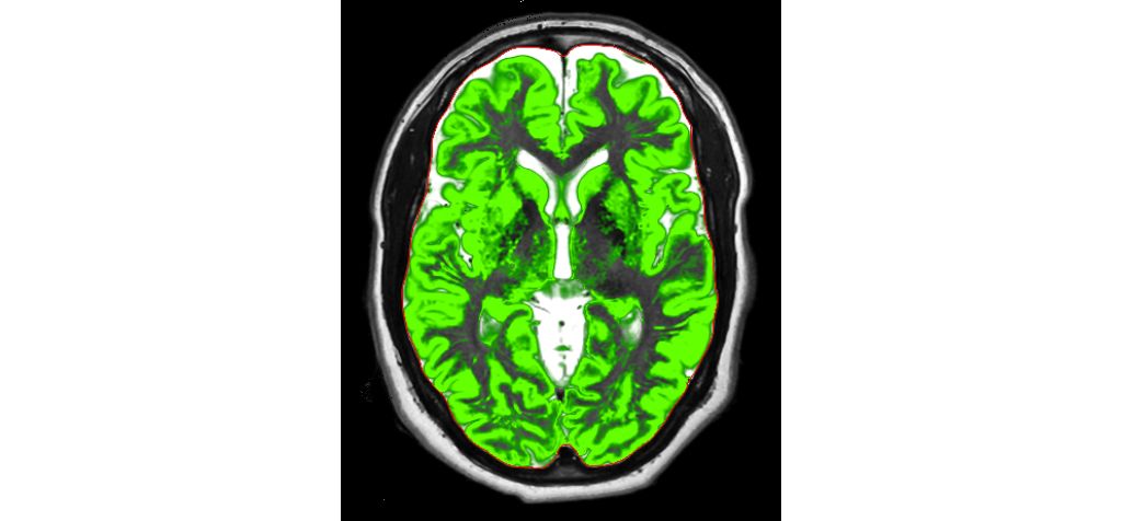 Segmentation Grey matter (synthetic)