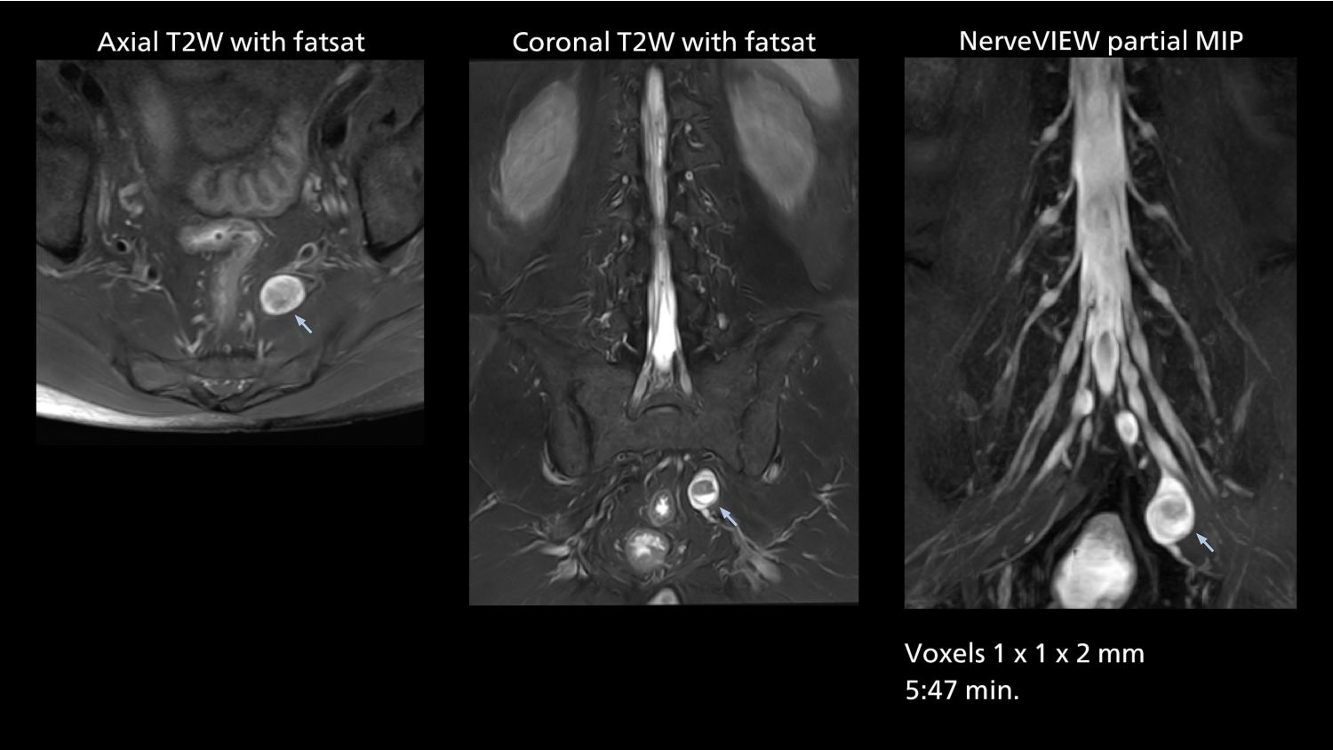 Peripheral nerve sheet tumor (schwannoma) with MR neurography