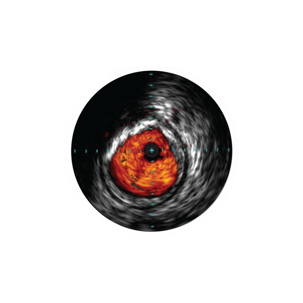 IVUS assesses disease