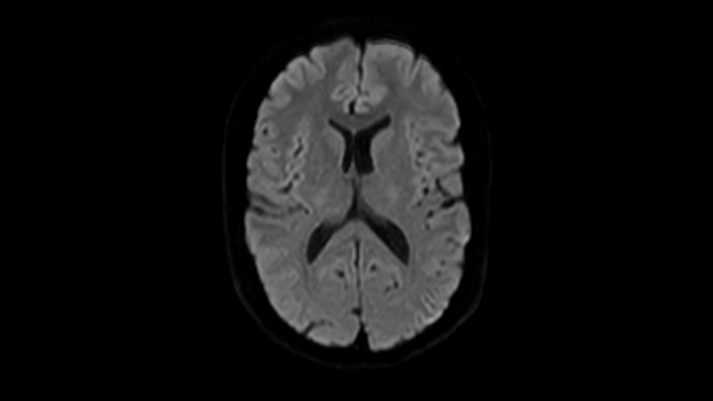 DWI b1000 clinical image of the brain