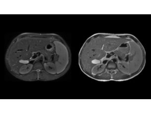 SmartSpeed MotionFree Body - Abdomen Applications cliniques IRM