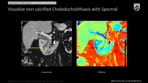 CT Spectral 7500 Choledocholithasis CBD