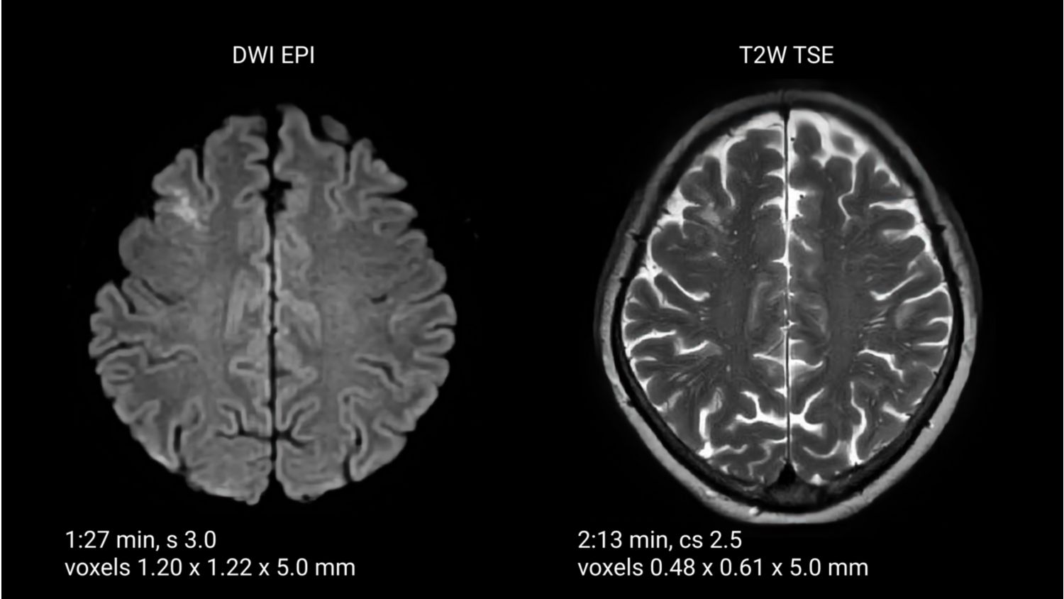 Brain MRI showing an old cerebral infarction